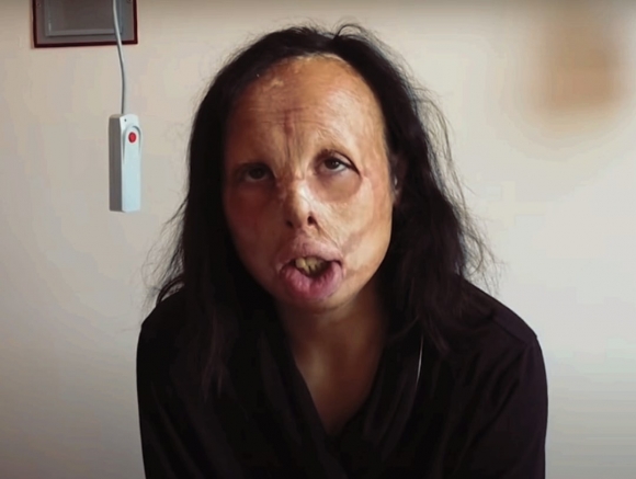 «Девушке без лица» сделали операцию по пересадке кожи